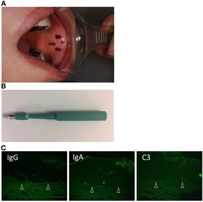 Direct Immunofluorescence Using Non-Lesional Buccal Mucosa in Mucous Membrane Pemphigoid